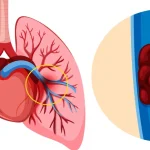 علائم آمبولی ریه